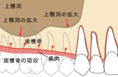 顎関節症の悪循環