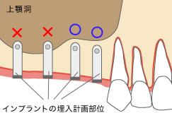 顎関節症の悪循環