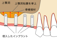 顎関節症の悪循環