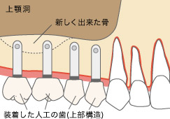 顎関節症の悪循環